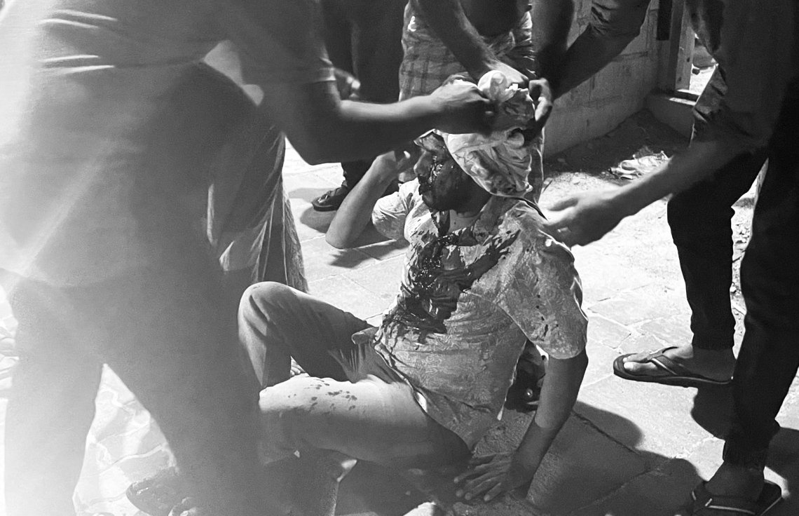 ރާމާރީގައި ޒަހަމްވި ބިދޭސީ މީހާ: ކޯރާޑިއަކުން ޖަހައި އޭނާގެ ބޯ ވަނީ ވަރަށް ބޮޑަށް ފަޅާލައިފައި -- ފޮޓޯ: މިހާރު