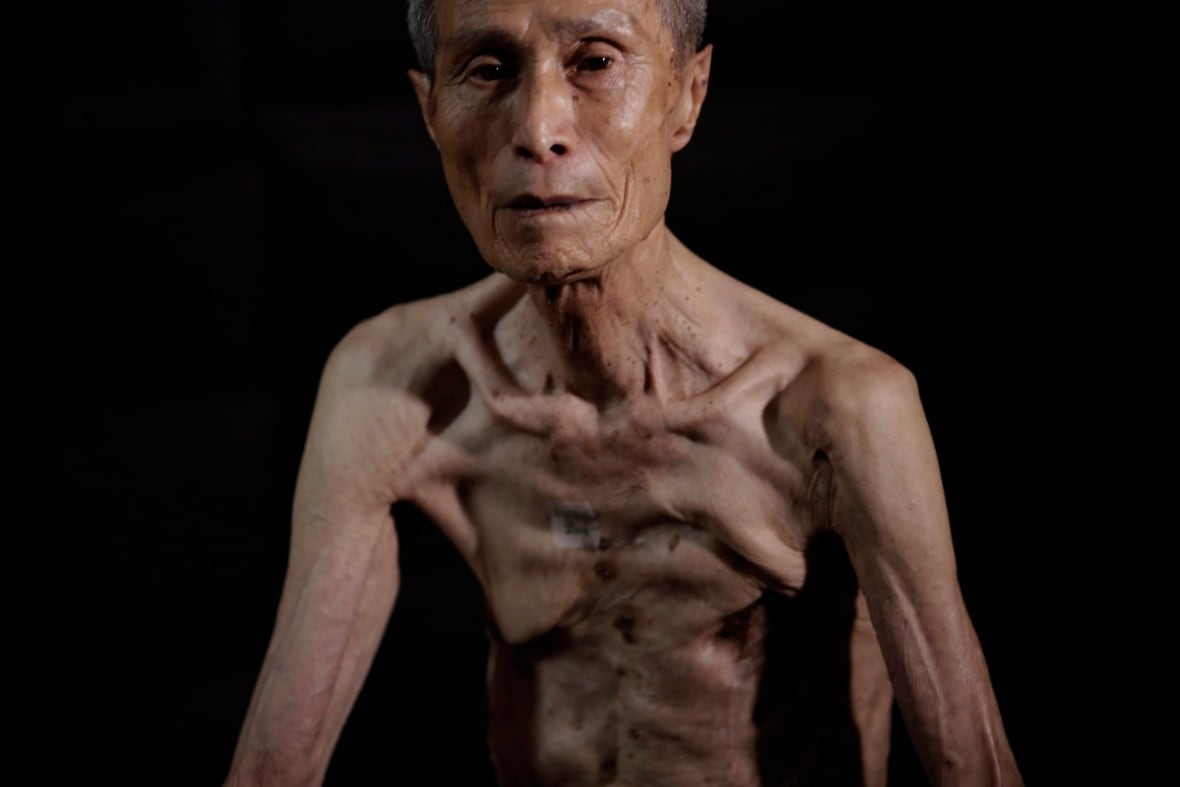 japan-a-bomb-one-man-scars-photo-essay